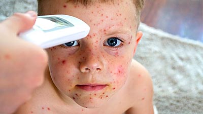Clade 9: New Strain Of Chicken Pox Causing Virus Found In India, Here&rsquo;s How You Can Protect Yourself 